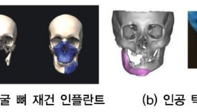 제4차 산업혁명과 3D프린팅 3편 - 3D프린팅 기술과 인간의 건강 